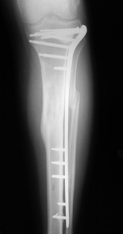 Tibia, Shaft:  Synthes L.I.S.S. (Implant 249)